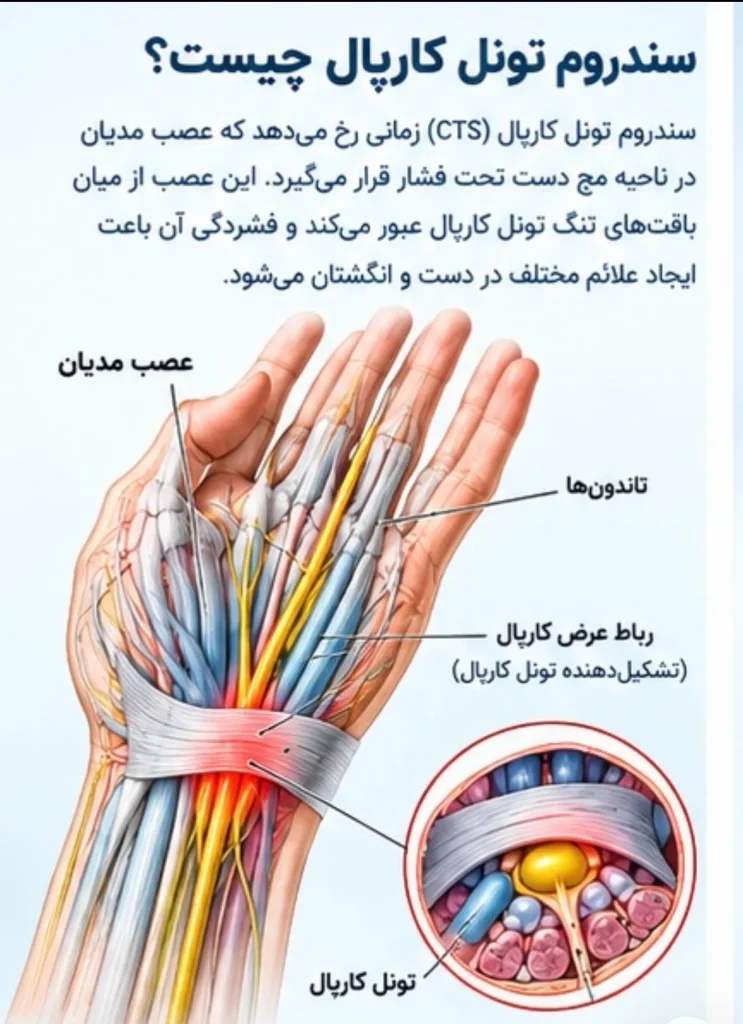 سندرم تونل کارپال