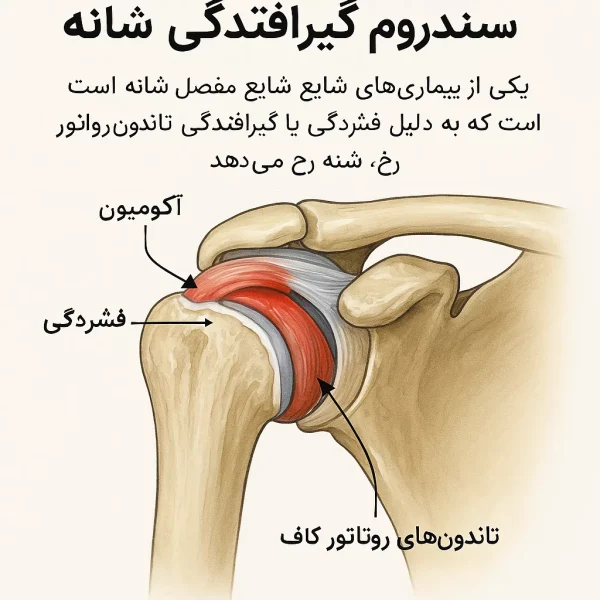 بورسینت-شانه